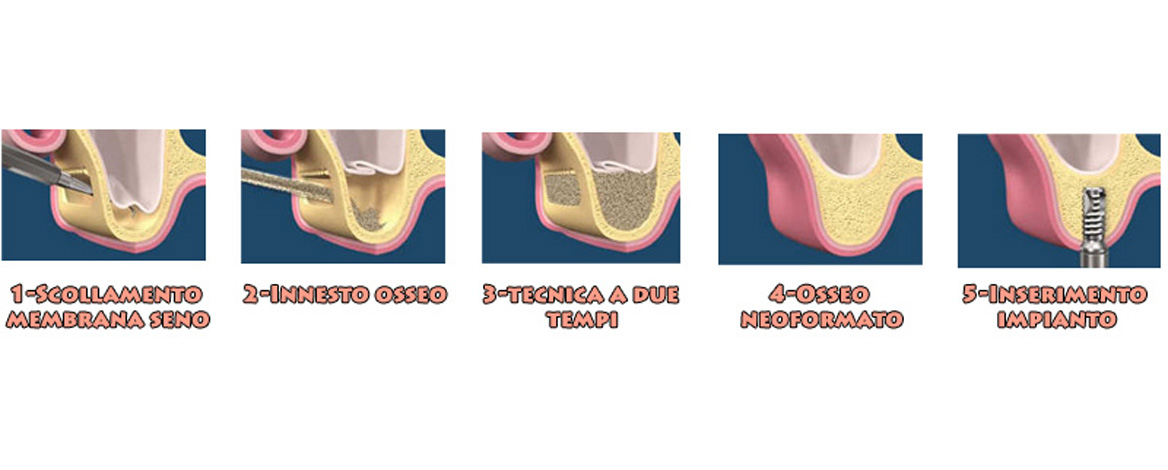 CHIRURGIA PRE- PROTESICA