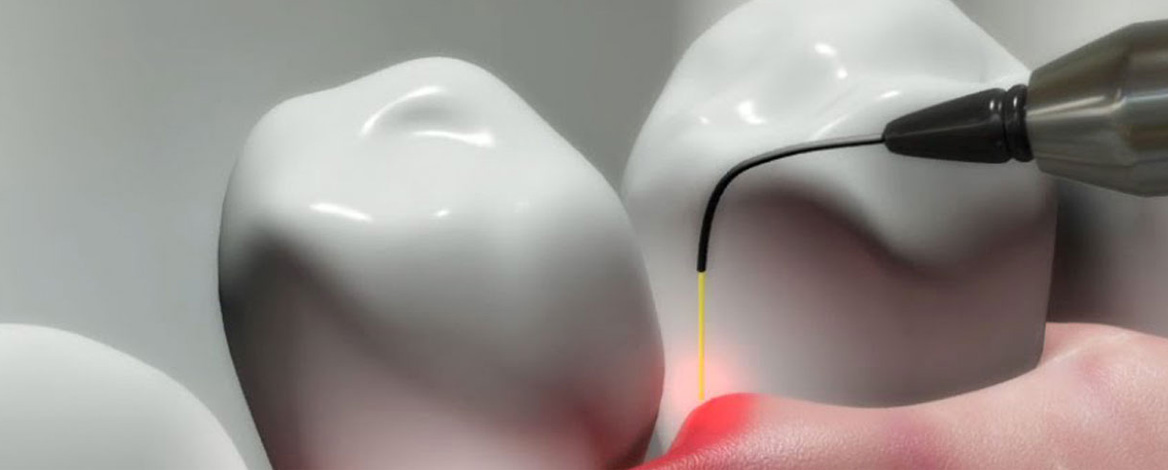 LASER E LASERTERAPIA