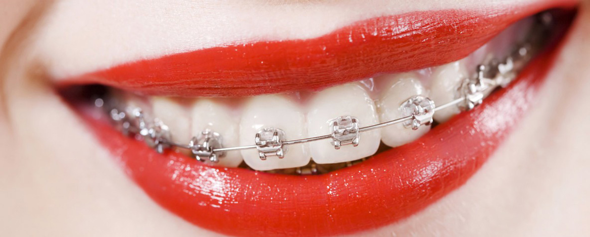 ORTODONZIA TRADIZIONALE